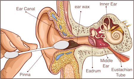cotton swab pushing cerumen into the ear canal