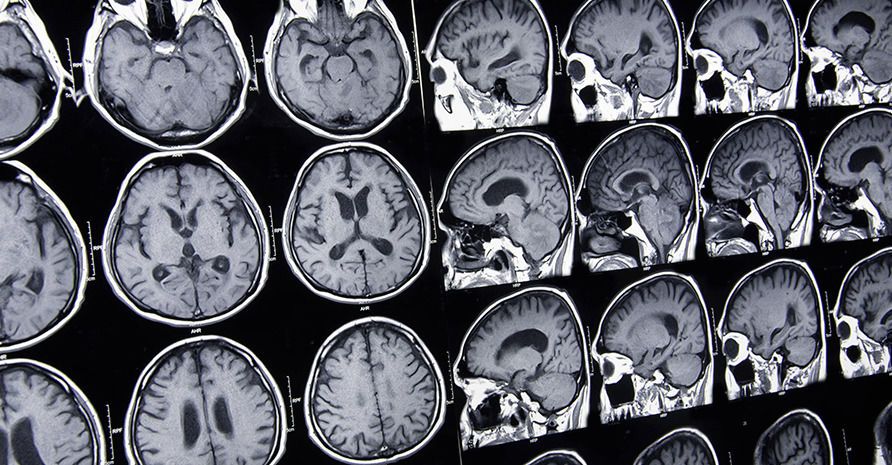 Multiple black-and-white scans showing a human brain from different angles